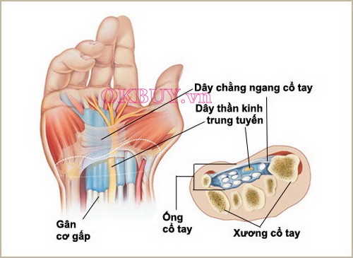 Viêm gân quấn cổ tay quay có thể làm cho bạn thường xuyên bị đau vai gáy làn xuống cánh tay